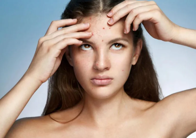 Young Woman Touching Acnes on Her Forehead