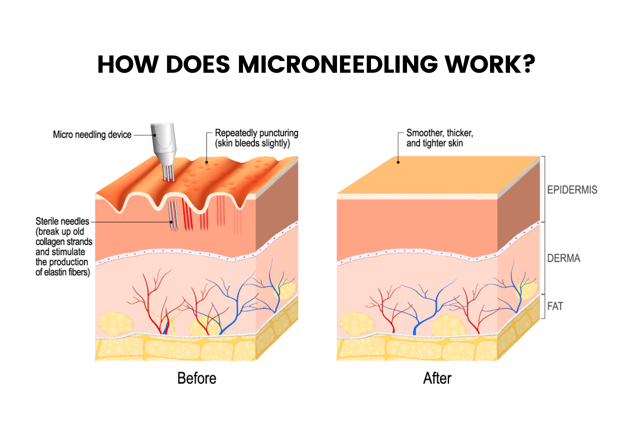Before And After Micro needling