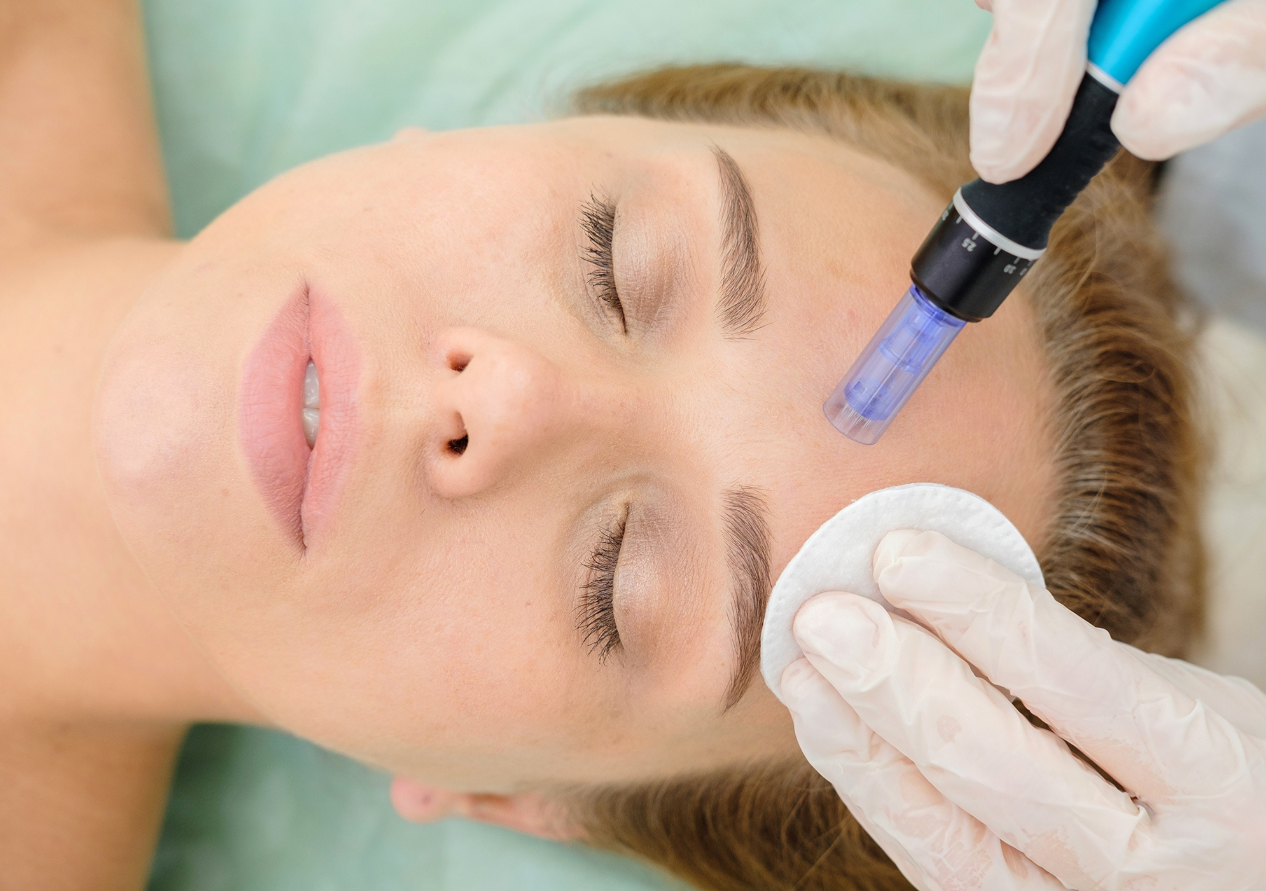 Microneedling Therapy in a Beauty Clinic