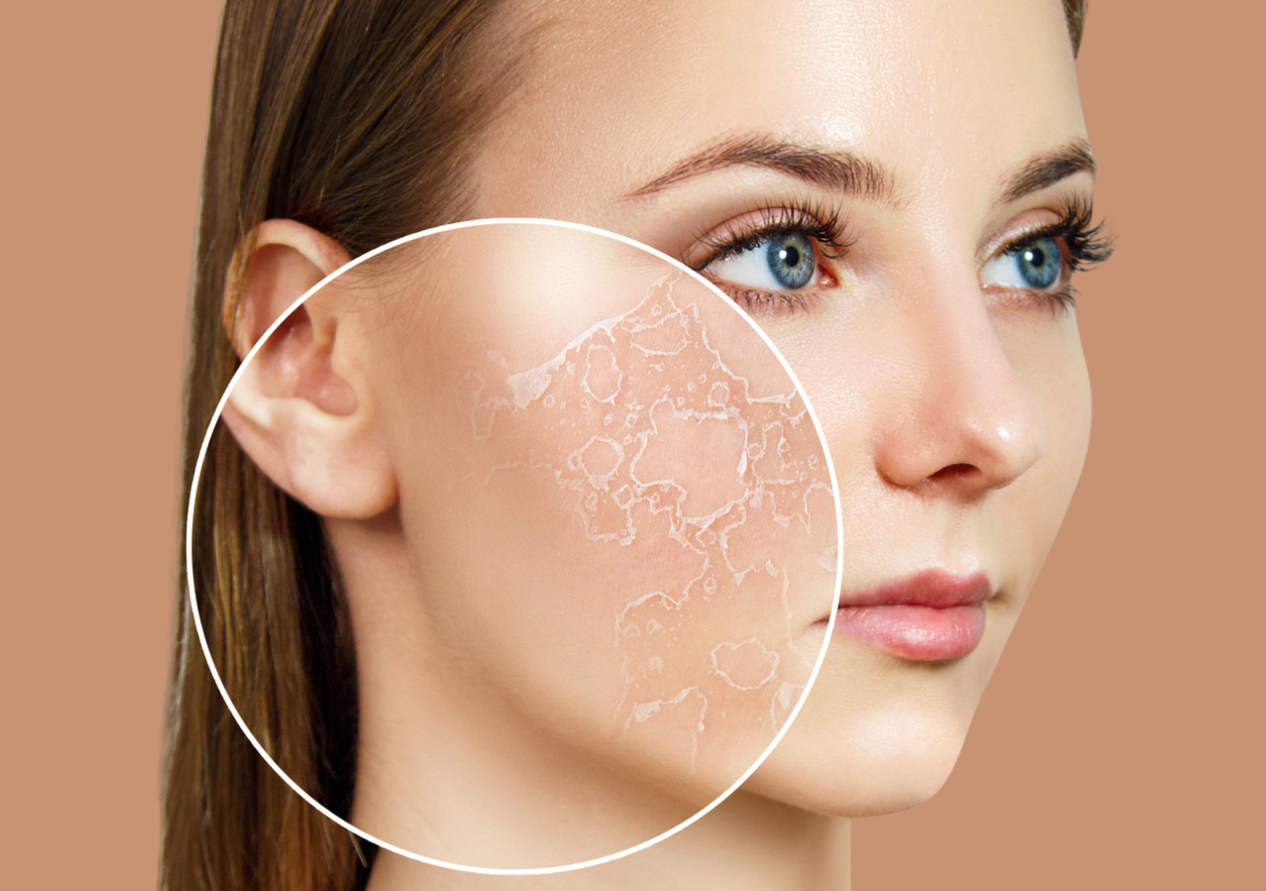 The Symptoms of Dehydrated Skin