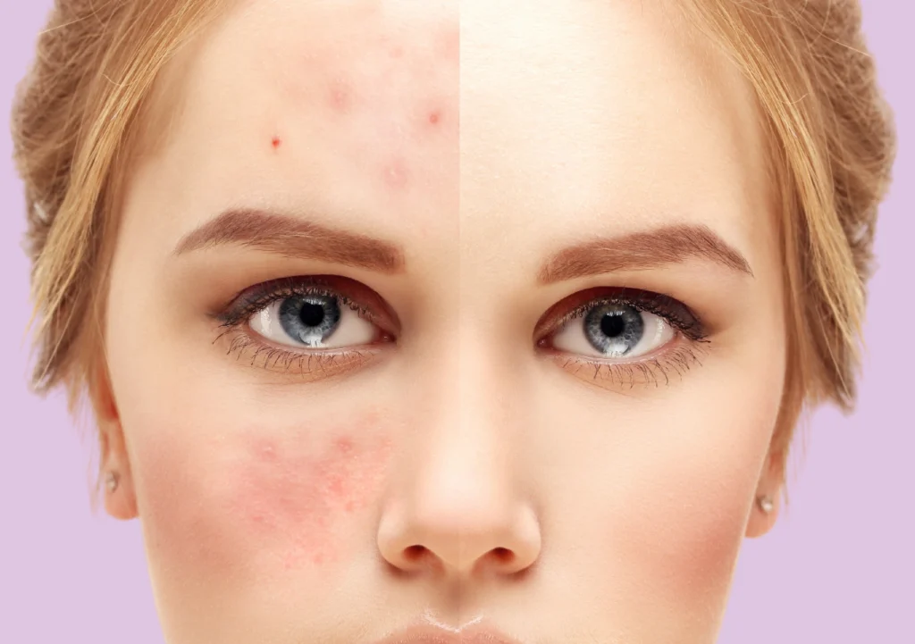 The Hidden Link Between Stress and Skin Problems: What You Need to Know