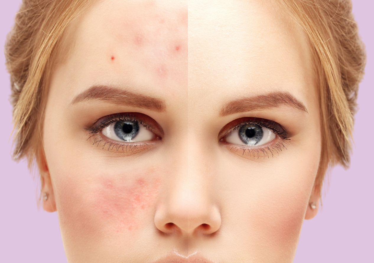 Link Between Stress And Skin Problems